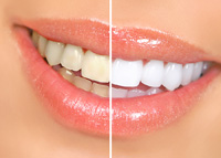 before and after teeth whitening, North York, ON cosmetic dentistry
